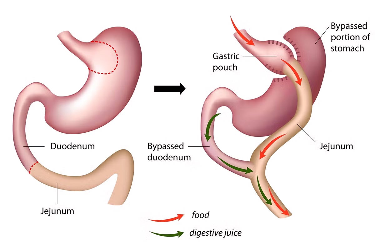 Roux-en-Y Gastric Bypass Procedure