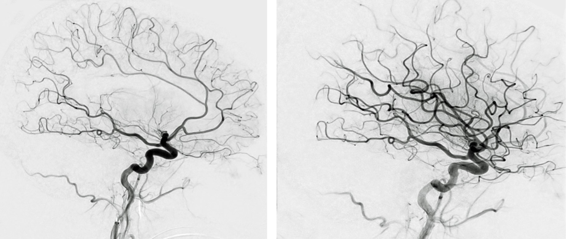 stroke before and after