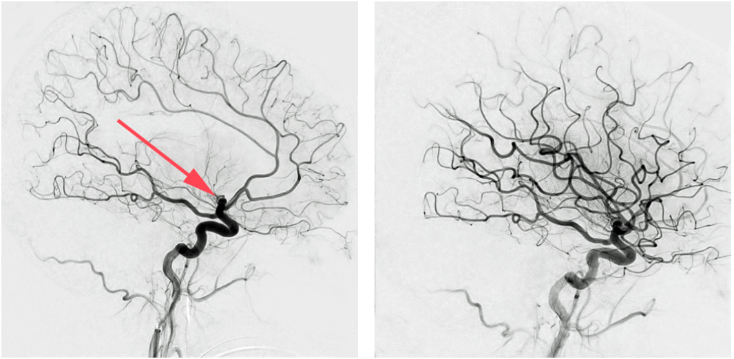 brain stroke before and after