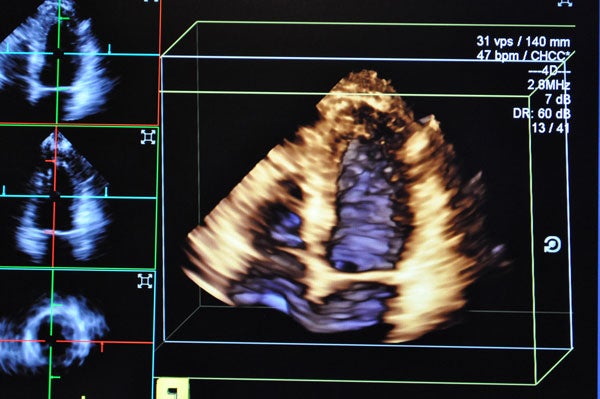 Echocardiography image