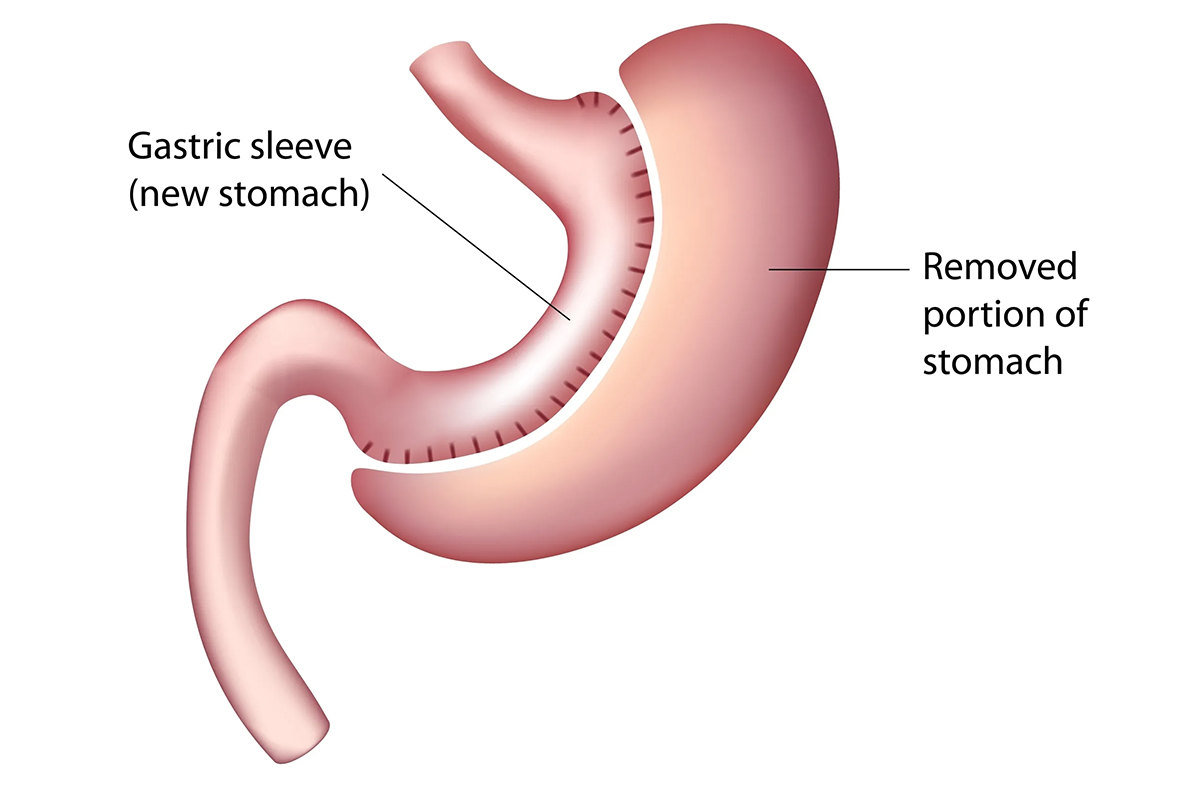 Vertical Sleeve Gastrectomy