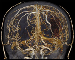 brain scan ct scan