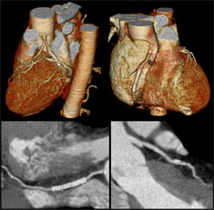 heart scan on ct