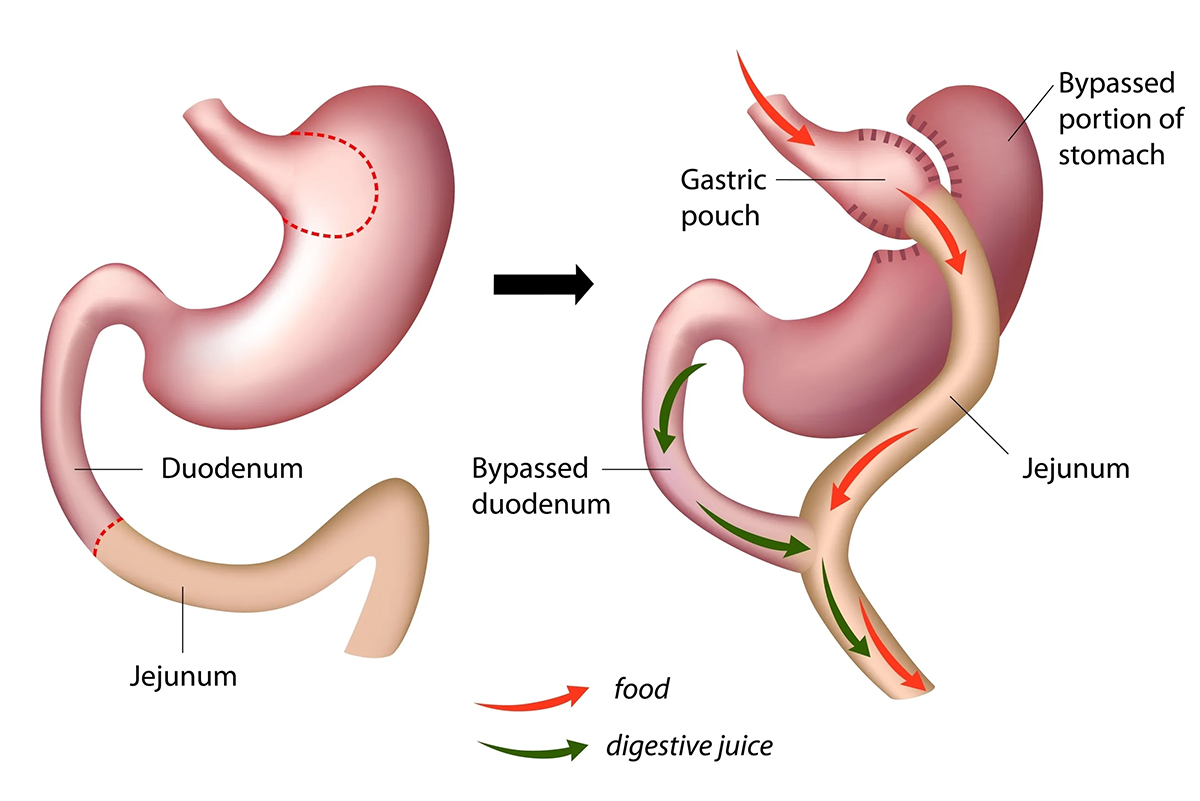 Roux-en-y Gastric Bypass Procedure